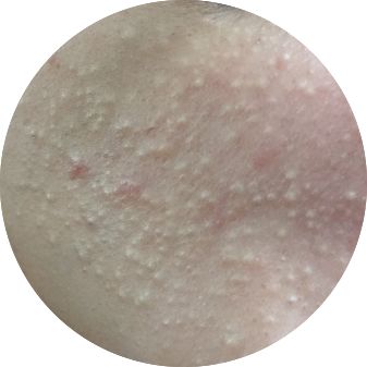 揭秘｜掰着指头数数被痘痘骚扰了多少年？弘叔帮你终止在今年夏天！（上）