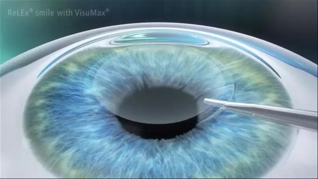 全飞秒和半飞秒治近视可重复做吗,全飞秒与半飞秒的治疗效果