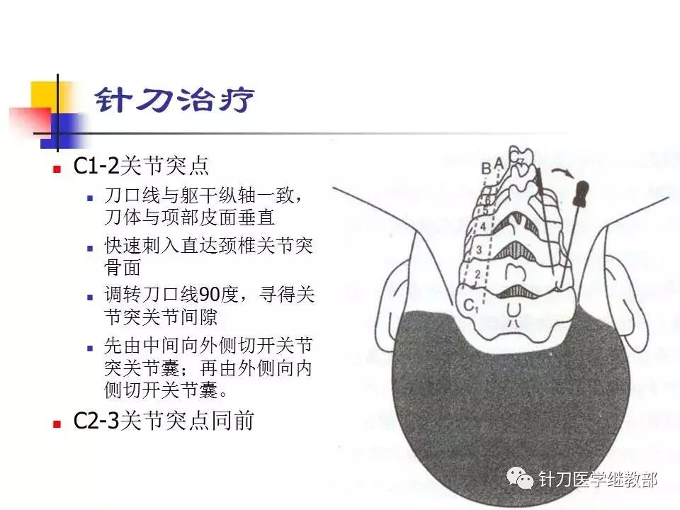 椎动脉型颈椎病错位了怎么治疗,颈椎寰枢关节错位复位手法