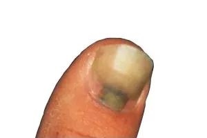 看指甲识健康,从指甲看疾病的图片说明