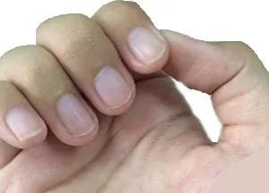 看指甲识健康,从指甲看疾病的图片说明