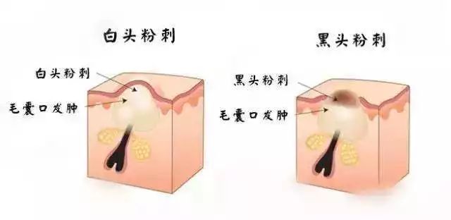 简单实用的去黑头方法,去黑头小妙招13岁