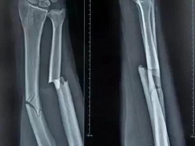 骨折康复期间的护理知识,骨折中医康复好还是西医康复好