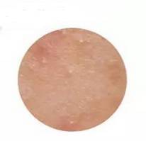 去闭口和痘痘,什么是闭口怎么去闭口最有效