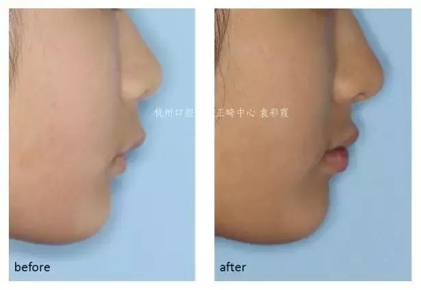 原来，上牙盖住下牙太多，也对牙齿有伤害！该怎么矫正？