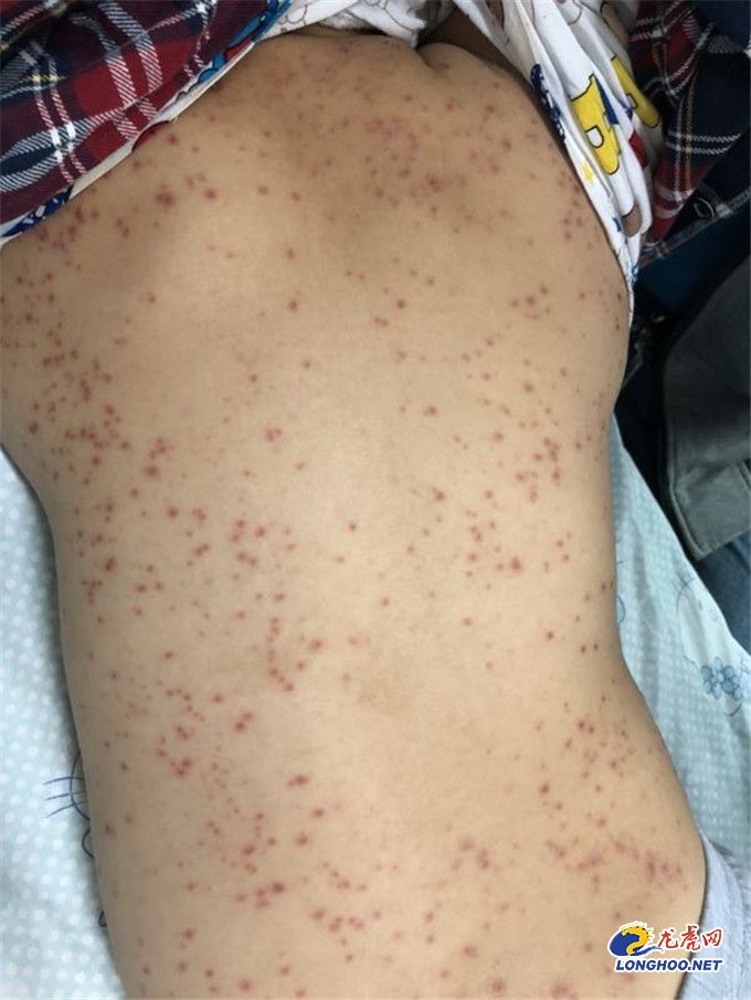 5岁孩子高烧是幼儿急疹么,5岁孩子高烧不退嘴巴长满溃疡