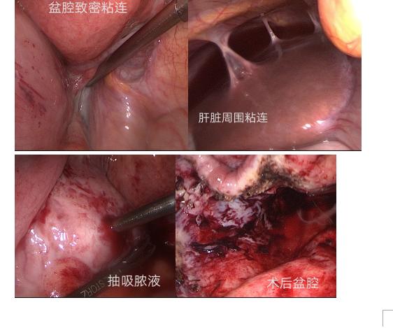 盆腔炎小便疼痛是怎么回事,盆腔炎老是想大便怎么回事