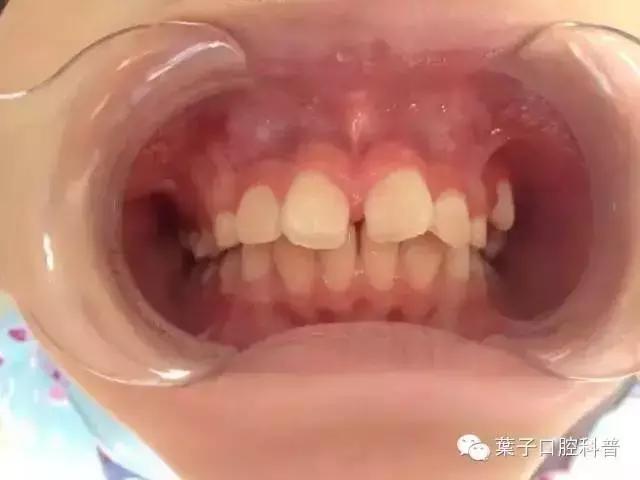 口腔科普儿童换牙常识,儿童换牙后牙缝大需要做矫正吗