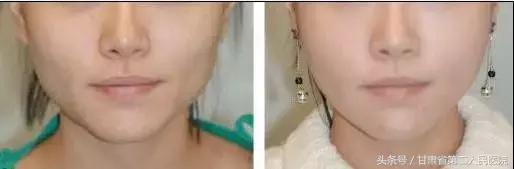 关于瘦脸针的知识解析,关于瘦脸的那些事