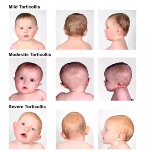 两个多月宝宝头型有些扁怎么纠正,宝宝两个月头型怎么才标准