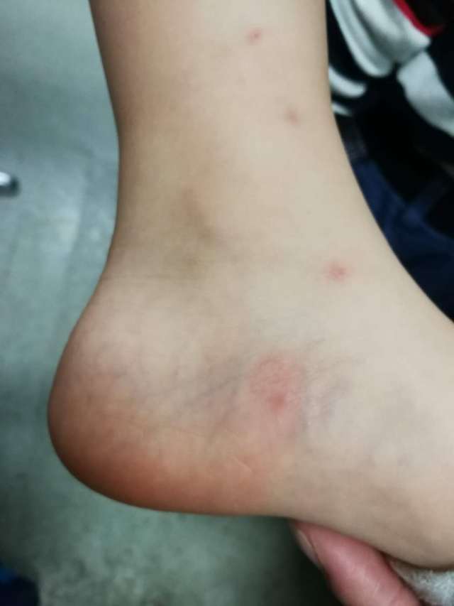 被蚊子咬了起了荨麻疹,被蚊子咬了起荨麻疹