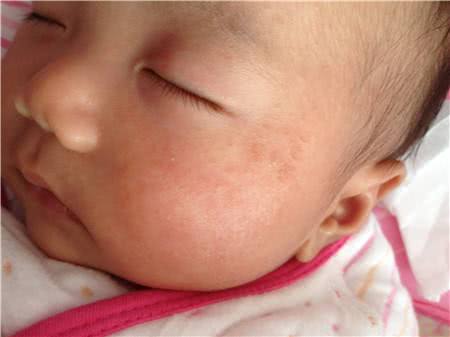 婴儿湿疹跟奶粉有关吗,婴儿湿疹是因为奶粉引起的吗