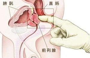 痔疮出血与肠癌出血辨别,直肠癌是一直出血还是间歇出血