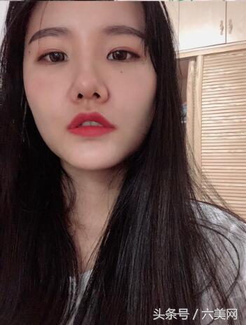 隆鼻后如何克服焦虑,隆鼻后前三天状态