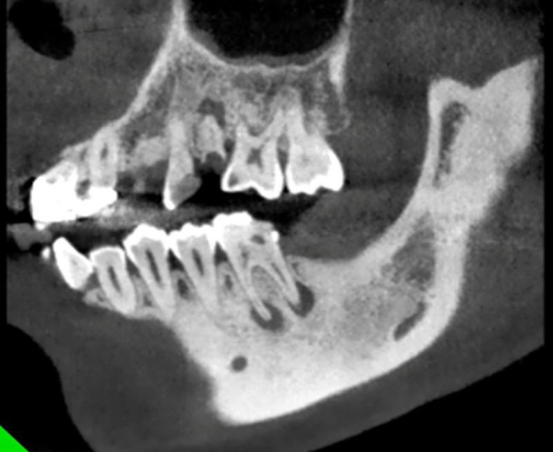 战痘多年才知道的真相,战痘多年不见效果