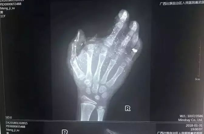 惊险！玉林一男孩玩手机突然爆炸，手脱皮起泡！你还敢这样做吗?