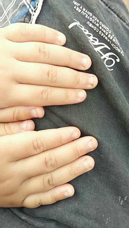 孩子指甲掉了还能去幼儿园吗,孩子在幼儿园指甲被门夹掉了