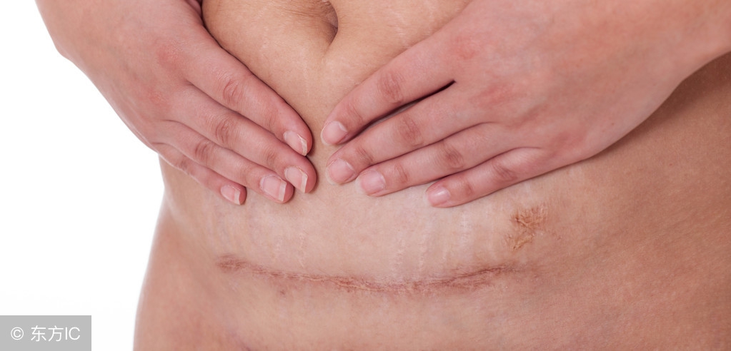 剖腹产4大后遗症有什么表现,剖腹产疤痕抹点什么可以淡化疤痕