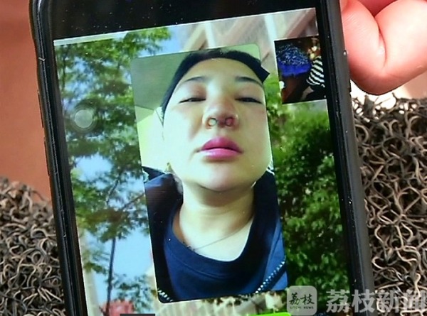 女子隆鼻后假体竟破鼻而出,隆鼻后鼻尖破了一洞