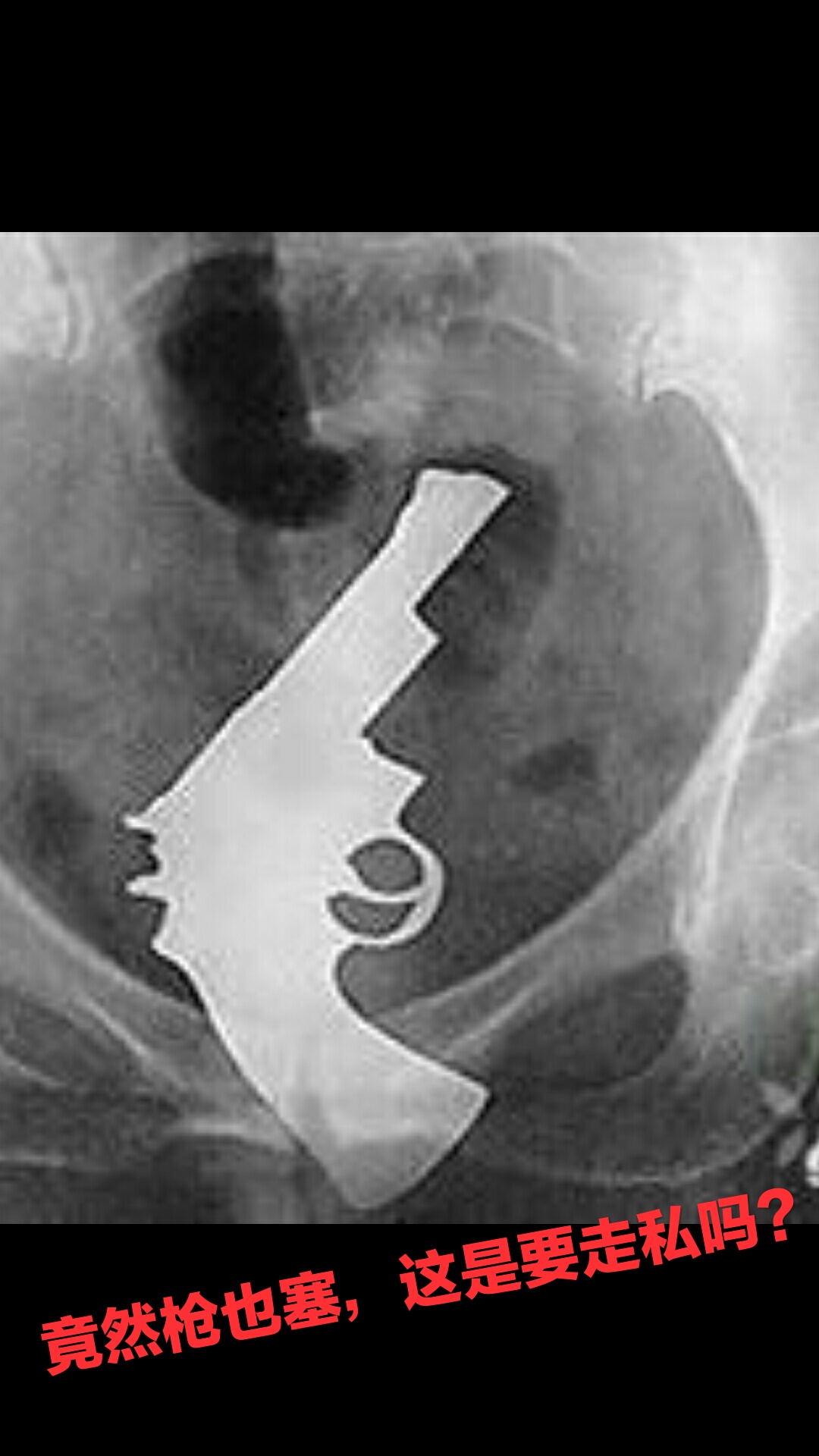 男子*处私**套螺母，动用消防官兵方破除，往*处私**乱塞异物，何苦？