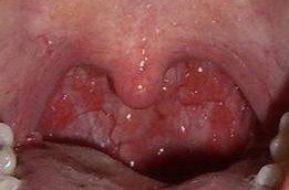 咽喉炎中医怎么治能除根慢性咽炎,中医治疗慢性咽炎有异物感