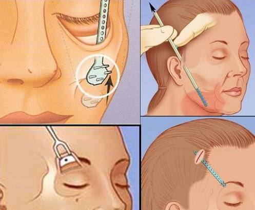 拉皮除皱手术真的有效吗,微创除皱手术与大拉皮除皱手术