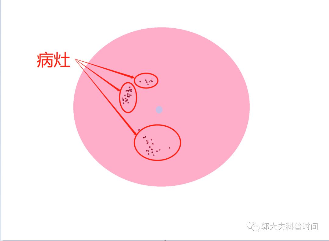 leep手术会导致子宫内膜变薄吗,leep手术为啥没有填塞纱布