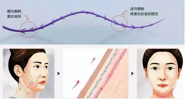 如何解决掉显老又讨厌的法令纹,法令纹不用愁一招帮你改善