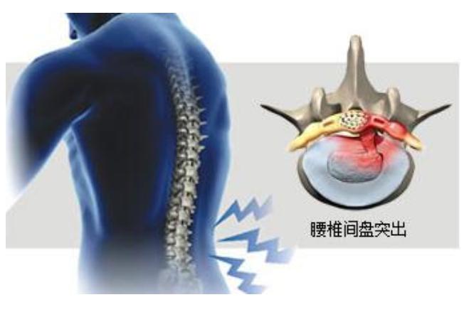 腰椎间盘突出腰腿不痛就是脚无力,腰椎间盘突出腰腿酸软无力中药