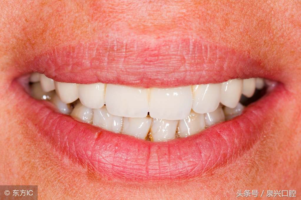 烤瓷牙优缺点,为什么不建议做烤瓷牙而是全瓷牙