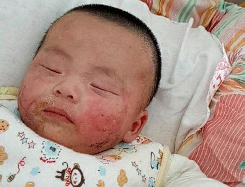 宝妈容易长痱子,宝妈长痱子