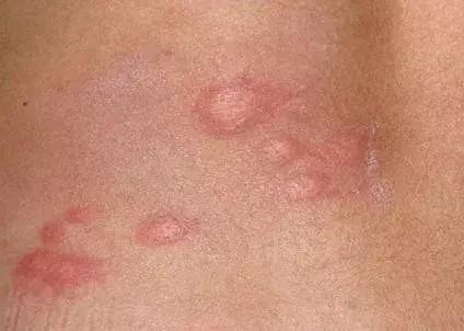 宝宝丘疹性荨麻疹后留下的红印子,宝宝身上出现红色荨麻疹