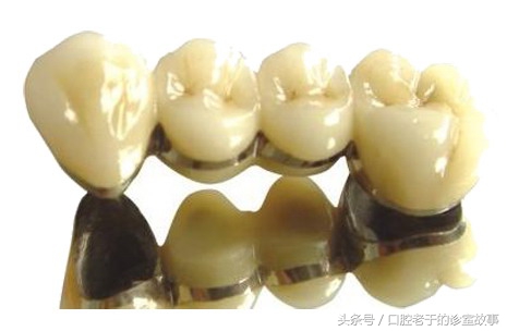 缺一颗牙种植好还是搭桥好,23岁下一排牙缺四颗可以矫正吗