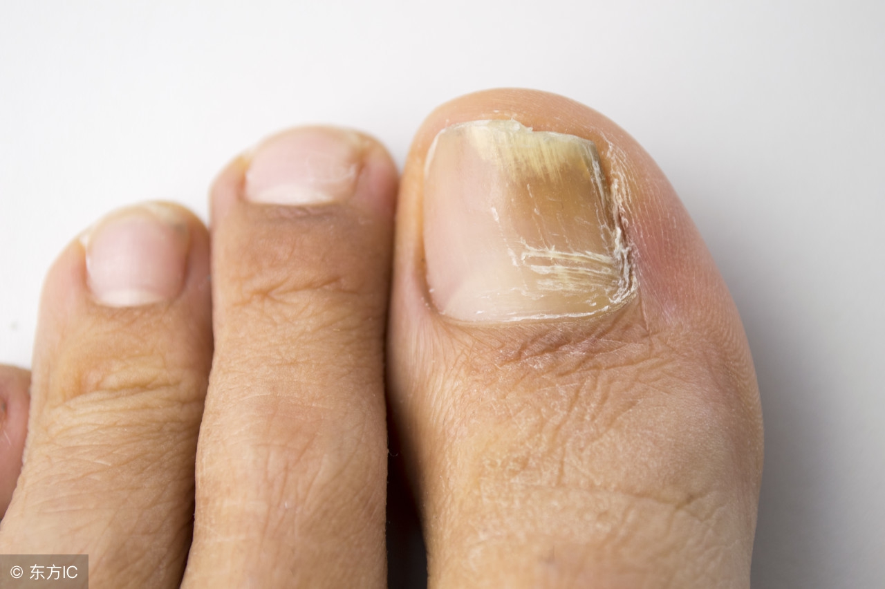 灰指甲祛除病甲后需要注意什么,和灰指甲患者接触应该注意什么