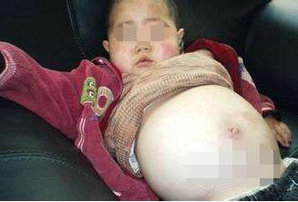 小孩得了肾病要怎么治疗,小孩子得了肾病怎么办