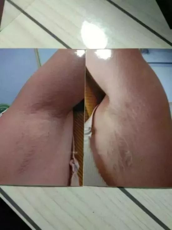 女子突然暴肥，竟是前夫下黑手，给她注射了69支激素？