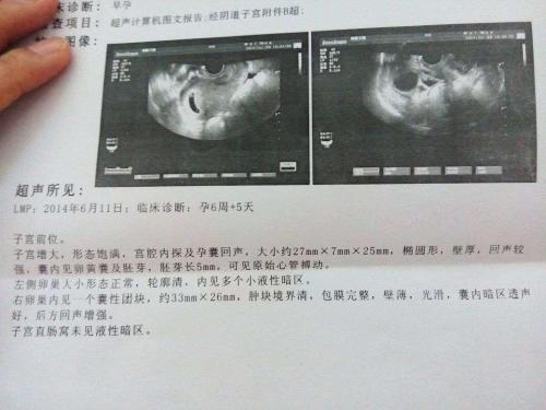 孕囊下方不规则无回声,孕囊无回声卵黄囊有回声不规则