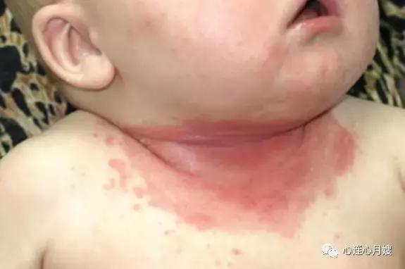 100多元的皮肤药膏,炉甘石有副作用怎么修复