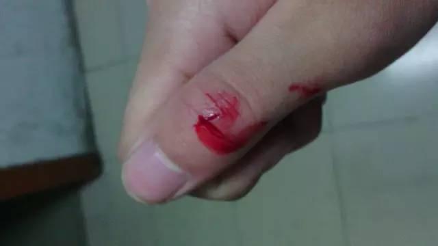 被a4纸划破是什么原因,为什么被a4纸划伤会更痛