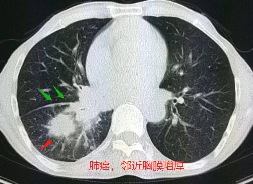 肺癌脑部转移还有脑血栓,脑梗查出肺结节怀疑肺癌