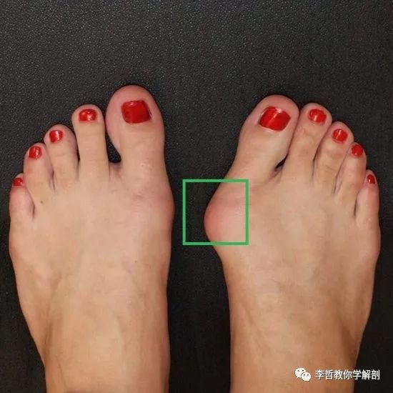 拇外翻该怎么办,拇外翻的解决方法