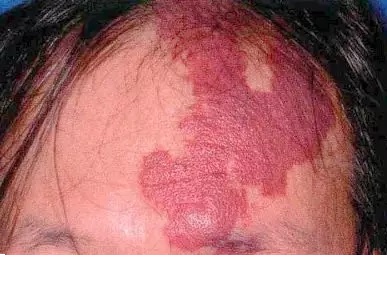 宝宝出生有青色胎记是怎么回事,宝宝出生有绿色胎记怎么办