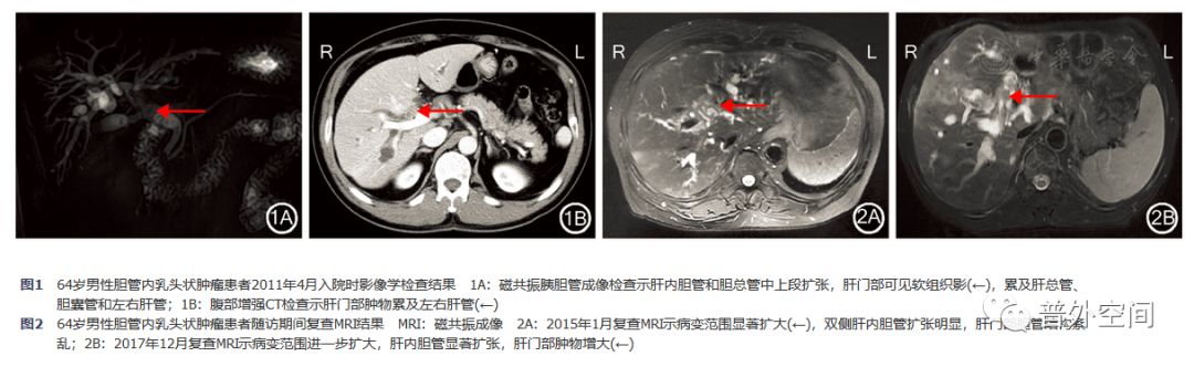 胆管良性肿瘤怎么治疗,胆管肿瘤如何治疗