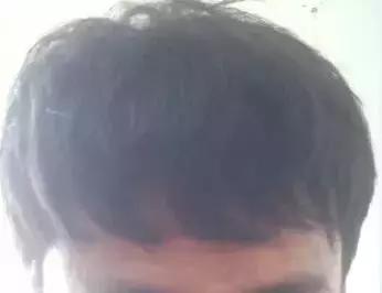 m型发际线,m型发际线怎么用发迹粉