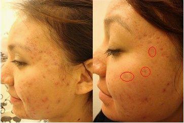 男士祛痘印痘疤痘坑哪个最好,祛痘印痘坑修复男生好物推荐