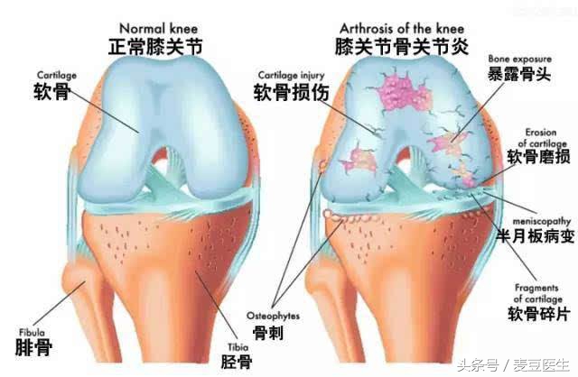 膝盖咯吱响疼痛什么原因,膝盖疼咯吱咯吱响是什么原因