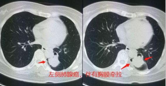 肺结节肺癌早期手术了会没事吧,肺结节肺癌早期手术能活多久