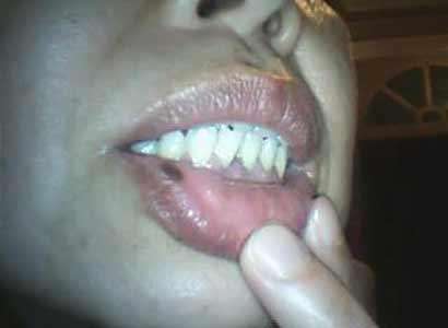 嘴唇上出现黑斑与肠胃疾病,下嘴唇上有黑斑就是胃有问题吗