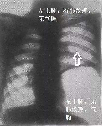 这样的气胸不少见，胸腔穿刺需谨慎！