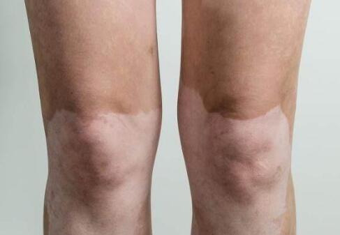 邯郸哪里有看白癜风的老中医,邯郸有个地方看白癜风